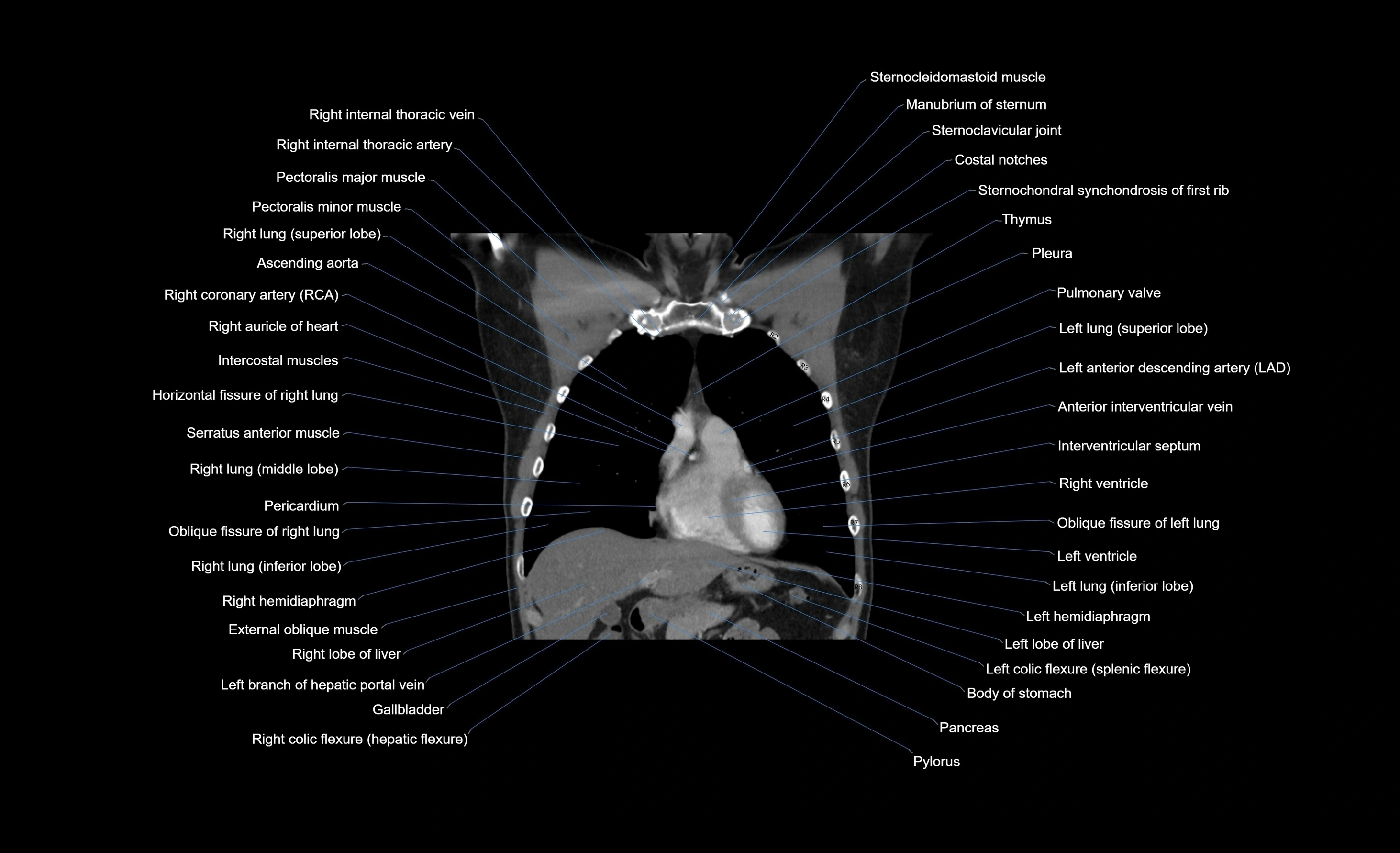 CT chest (thorax) labelled coronal cross sectional anatomy radiology image-00083.webp